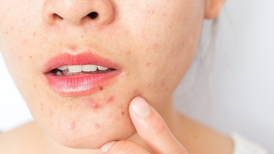 Dermatologët kofirmojnë: Këto janë ushqimet më të këqija për lëkurën tuaj