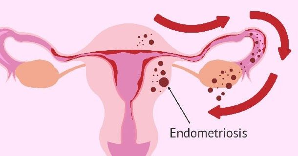 Endometrioza ka të ngjarë të përbëjë një rrezik të shtuar tek gratë për kancer të vezoreve