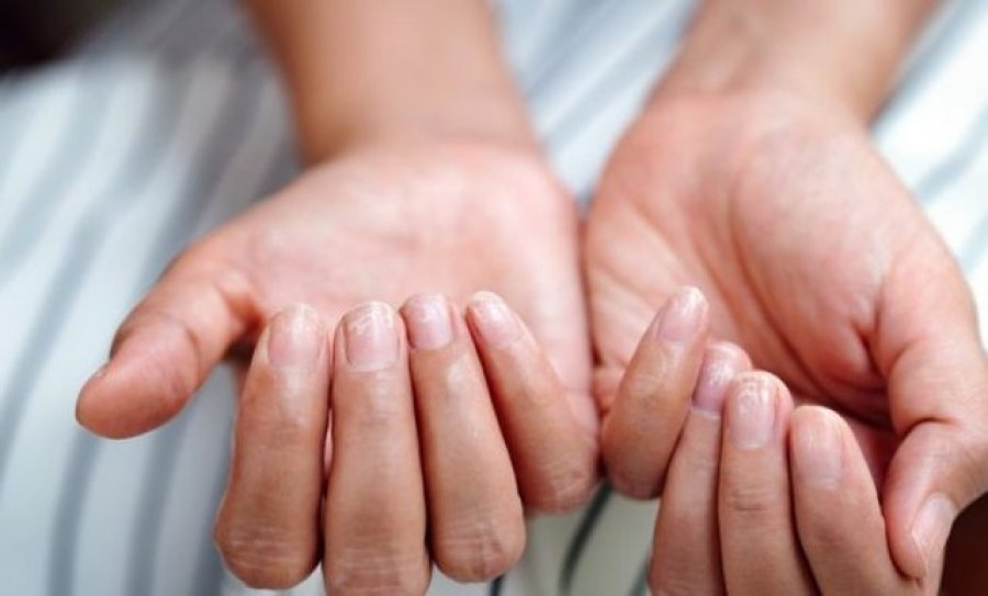 10 simptomat që zbulojnë mungesën e hekurit në trupin tuaj